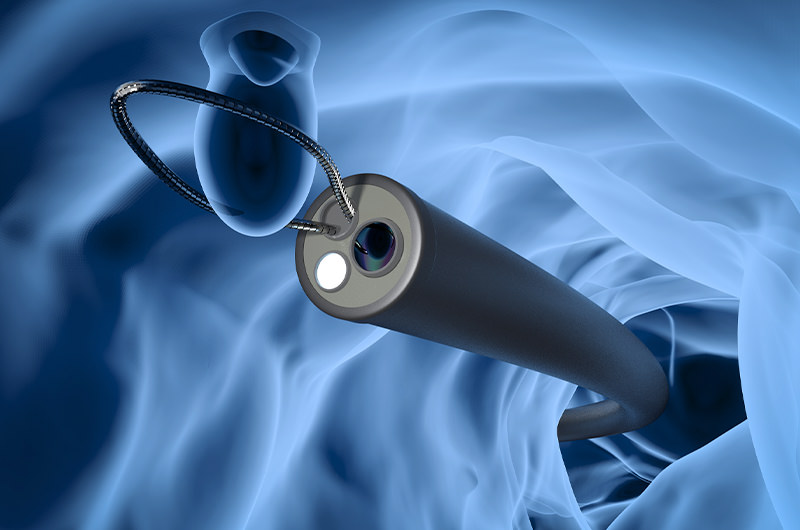 大腸ポリープの切除手術を日帰りで行えます