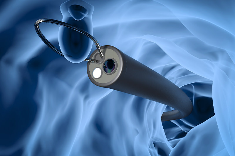 大腸ポリープ切除も可能