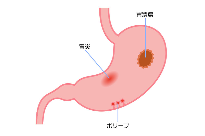 胃潰瘍・十二指腸潰瘍
