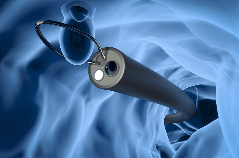 大腸ポリープとは