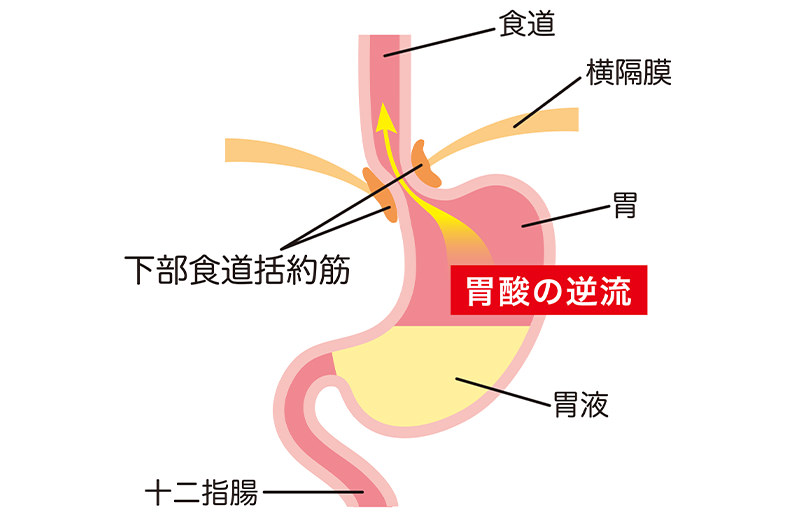 逆流性食道炎について